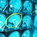 Symptoms of glioblastoma multiforme and when to call a professional