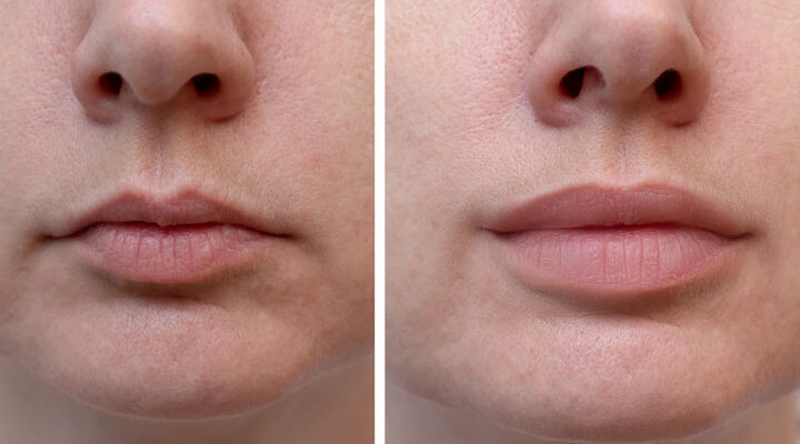 Lip Enhancement - Enhance Your Lips For a Complete Youthful Smile